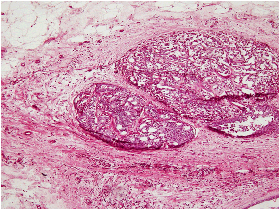 Papillotubular carcinoma